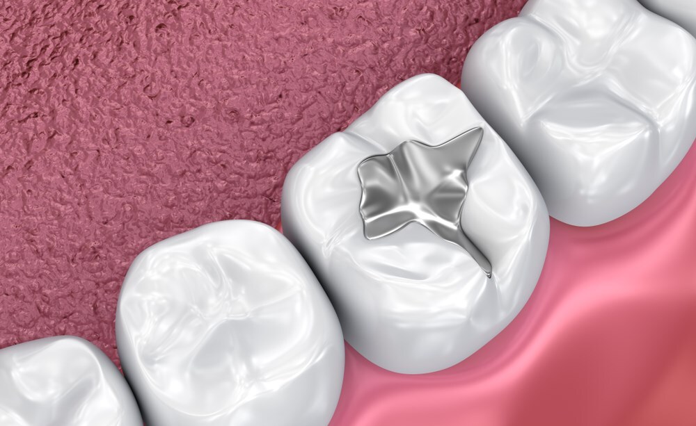 Post Operative Instructions For Fissure Sealant at Sharon Lim blog